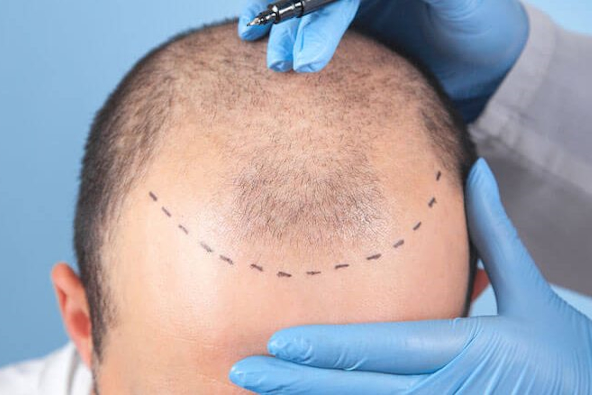 Saç Ekimi Hizmeti Görseli